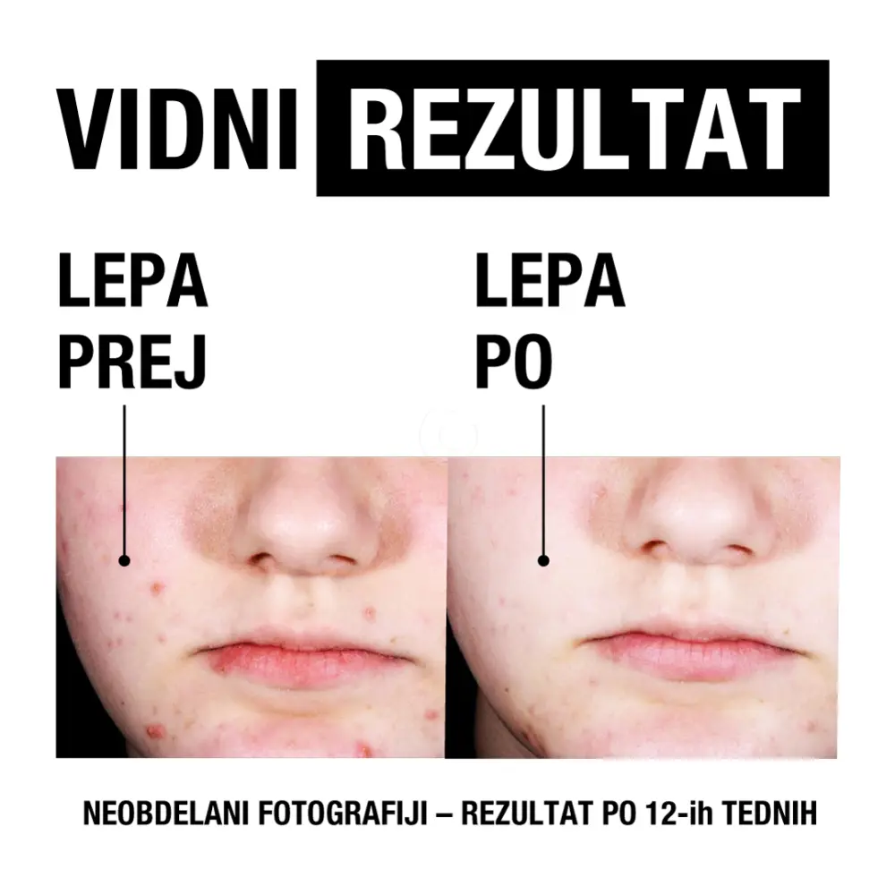 Neutrogena Clear&Defend+, serum za obraz (30 ml)